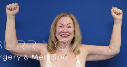 Body Contouring Before & After Patient #1027