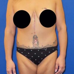 Body Contouring Before & After Patient #1038
