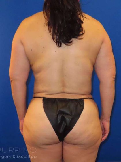Body Contouring Before & After Patient #1052