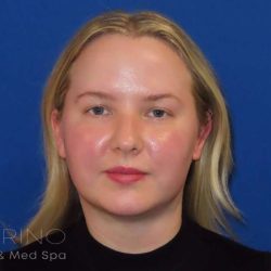 Smartlipo® Before & After Patient #463