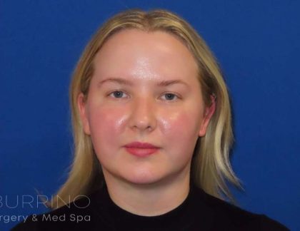Smartlipo® Before & After Patient #463