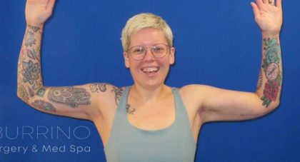 Arm Lift Before & After Patient #1096