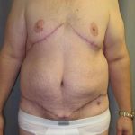 After Weight Loss Surgery Before & After Patient #1112
