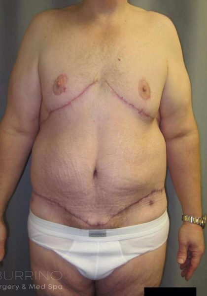After Weight Loss Surgery Before & After Patient #1112