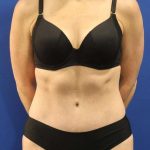 Tummy Tuck Before & After Patient #1153