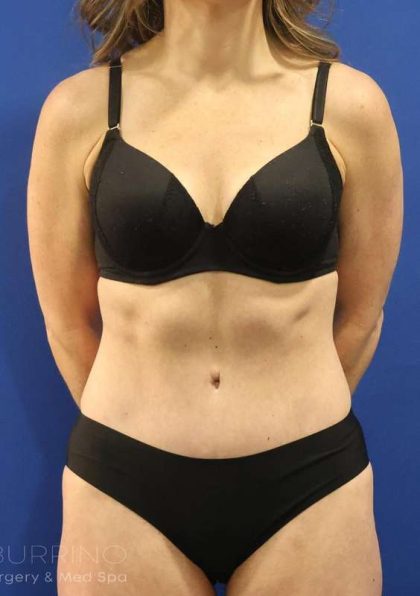 Tummy Tuck Before & After Patient #1153