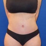 Tummy Tuck Before & After Patient #1190