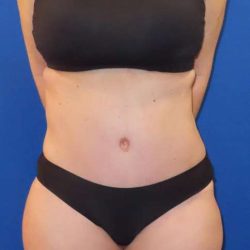 Tummy Tuck Before & After Patient #1190