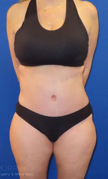 Tummy Tuck Before & After Patient #1190