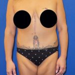 Tummy Tuck Before & After Patient #1214