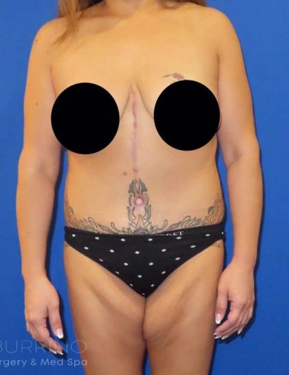 Tummy Tuck Before & After Patient #1214