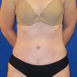 Tummy Tuck Before & After Patient #1236