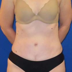 Tummy Tuck Before & After Patient #1236