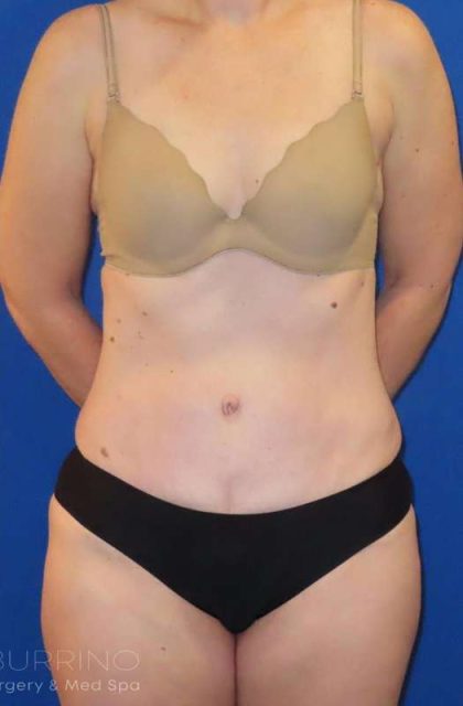 Tummy Tuck Before & After Patient #1236