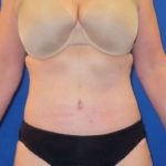 Tummy Tuck Before & After Patient #1273