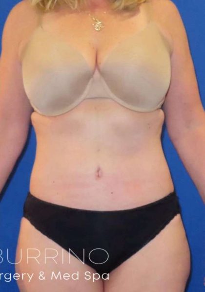 Tummy Tuck Before & After Patient #1273
