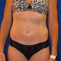 Tummy Tuck Before & After Patient #1284