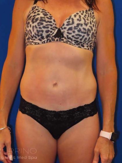 Tummy Tuck Before & After Patient #1284