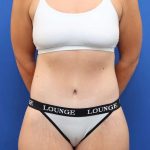 Tummy Tuck Before & After Patient #1343