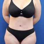 Tummy Tuck Before & After Patient #1356