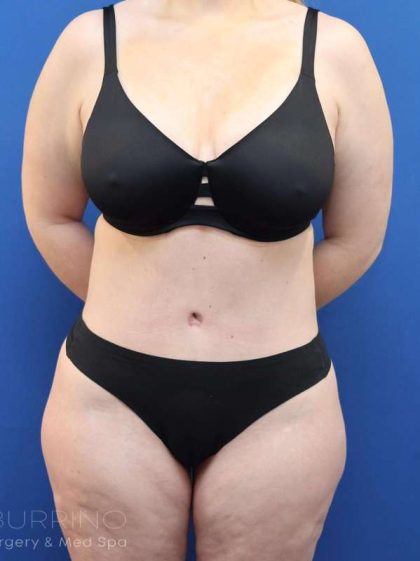 Tummy Tuck Before & After Patient #1356