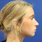 Rhinoplasty Before & After Patient #1415