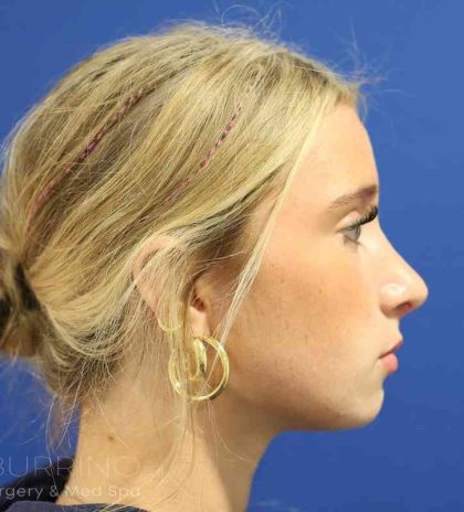 Rhinoplasty Before & After Patient #1415