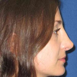 Rhinoplasty Before & After Patient #1424