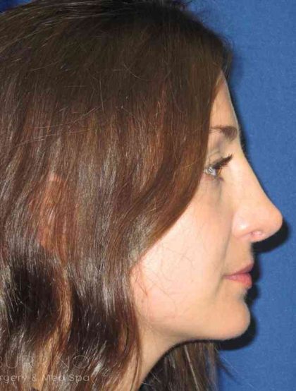 Rhinoplasty Before & After Patient #1424