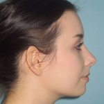 Rhinoplasty Before & After Patient #1439