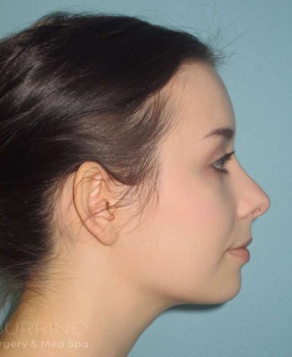 Rhinoplasty Before & After Patient #1439