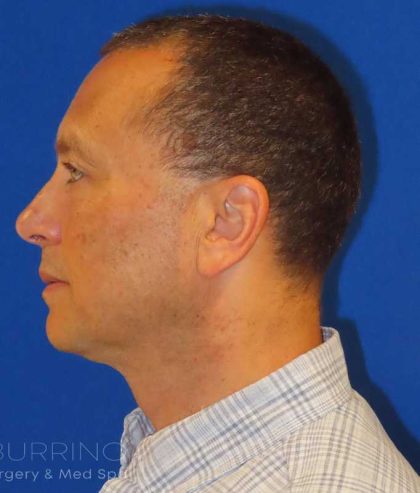 Neck Lift Before & After Patient #1598