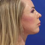 Facelift Before & After Patient #1609