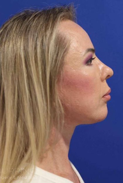 Facelift Before & After Patient #1609