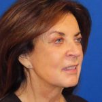 Facelift Before & After Patient #1631