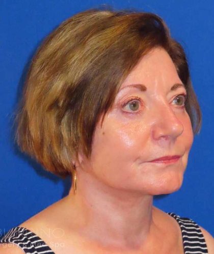 Facelift Before & After Patient #1642