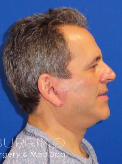 Facelift Before & After Patient #1653