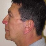 Facelift Before & After Patient #1664
