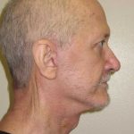 Facelift Before & After Patient #1675