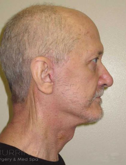 Facelift Before & After Patient #1675