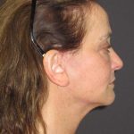 Facelift Before & After Patient #1682