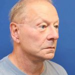Facelift Before & After Patient #1693