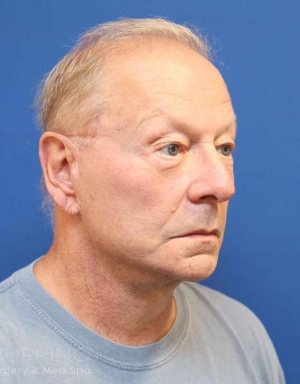 Facelift Before & After Patient #1693