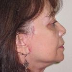 Facelift Before & After Patient #1700