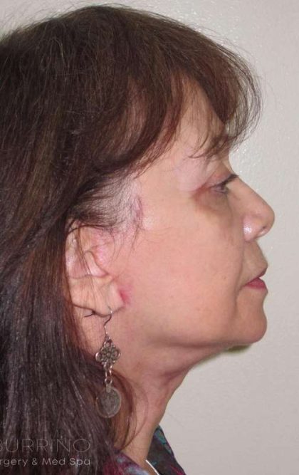 Facelift Before & After Patient #1700