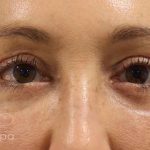 Eyelid Lift Before & After Patient #1708