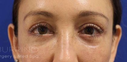 Eyelid Lift Before & After Patient #1708
