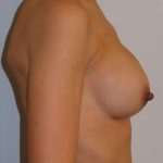 Breast Augmentation Before & After Patient #2047