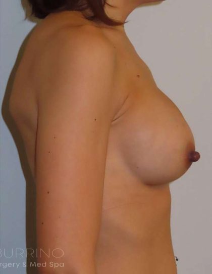 Breast Augmentation Before & After Patient #2047