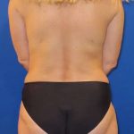 Breast Augmentation Before & After Patient #2101